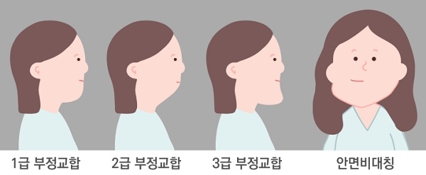 부정교합 1~3급별 옆얼굴 모습과 안면비대칭 모습.