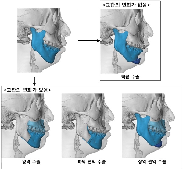 골격성 2급 부정교합(무턱)의 다양한 수술방법