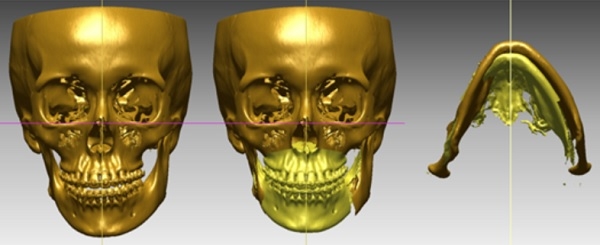 CAD/CAM 프로그램을 이용한 모의수술.