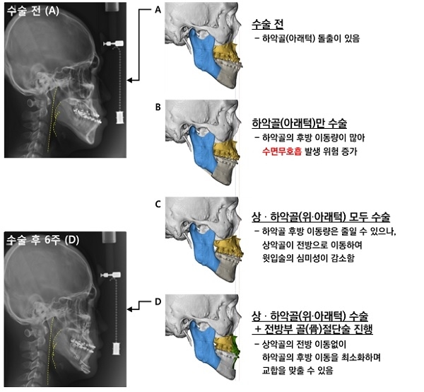 [그림 2] 윗입술이 튀어나온 정도가 적절한 주걱턱 환자가 수술 전 좁은 기도공간을 보일 때 적용 가능한 다양한 수술 계획(양악 수술과 위·아래턱 전방부 골(骨) 절단술을 동시에 시행하여 기도공간의 감소 없이 심미적·기능적으로 턱교정수술이 진행됨).