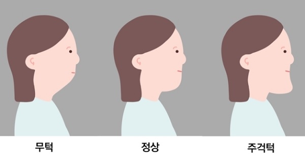 턱뼈의 위치 및 크기와 관련된 부정교합-무턱과 주걱턱.