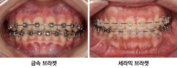 브라켓을 이용한 교정치료.