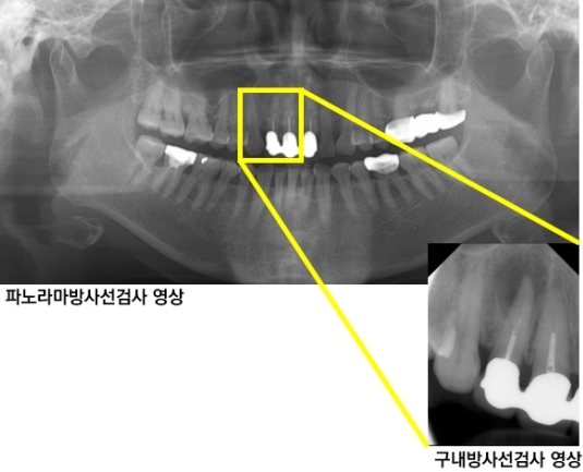 파노라마방사선검사와 구내방사선검사 영상.