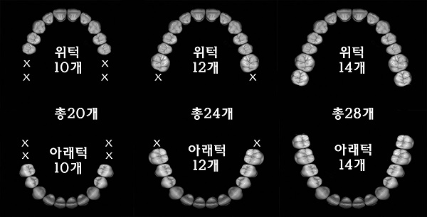 한국인은 위아래 큰어금니가 2개씩 맞물려야 정상적인 식사를 할 수 있다.