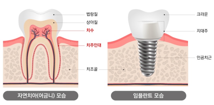 자연치아에 있는 치수나 치주인대가 임플란트에는 없다.
