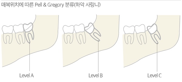 매복위치에 따른 사랑니 분류, 맹출된 위치에 따라 치료 난이도가 달라진다.(출처: 강동경희대학교병원 원보 For You 1+2월호)