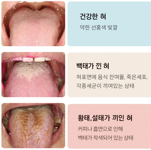 혀의 상태별 모습.