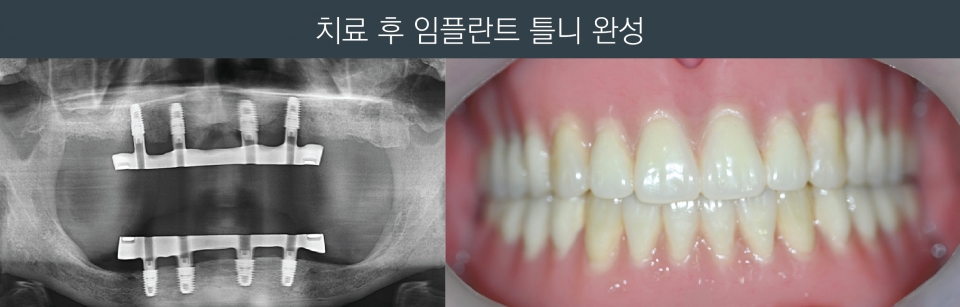 치아 임플란트 식립 전후 사진